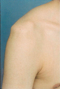 sulcus 徴候