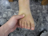 術者母指の部分を中心に浮腫があります。そこを押圧してみると・・・