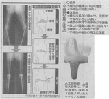 変形性膝関節症の進行