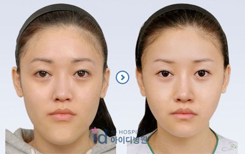 korean_plastic_surgery_47
