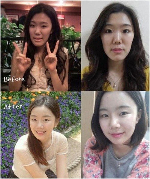 korean_plastic_surgery_34