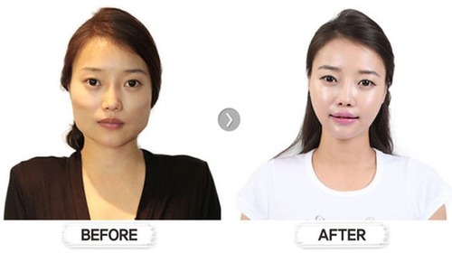 korean_plastic_surgery_23
