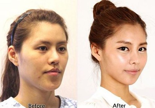 korean_plastic_surgery_10