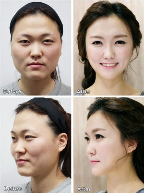 korean_plastic_surgery_44
