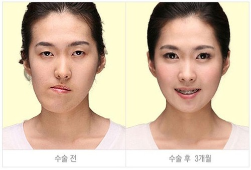 korean_plastic_surgery_28