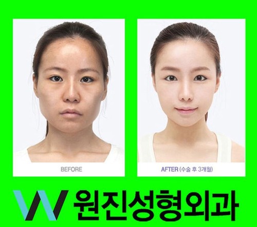 korean_plastic_surgery_27