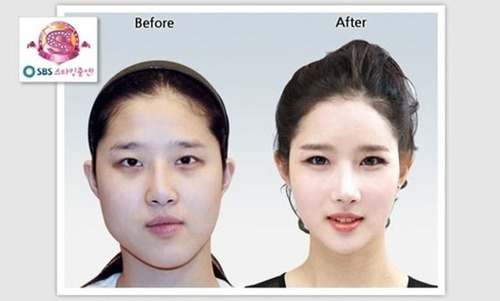 korean_plastic_surgery_33