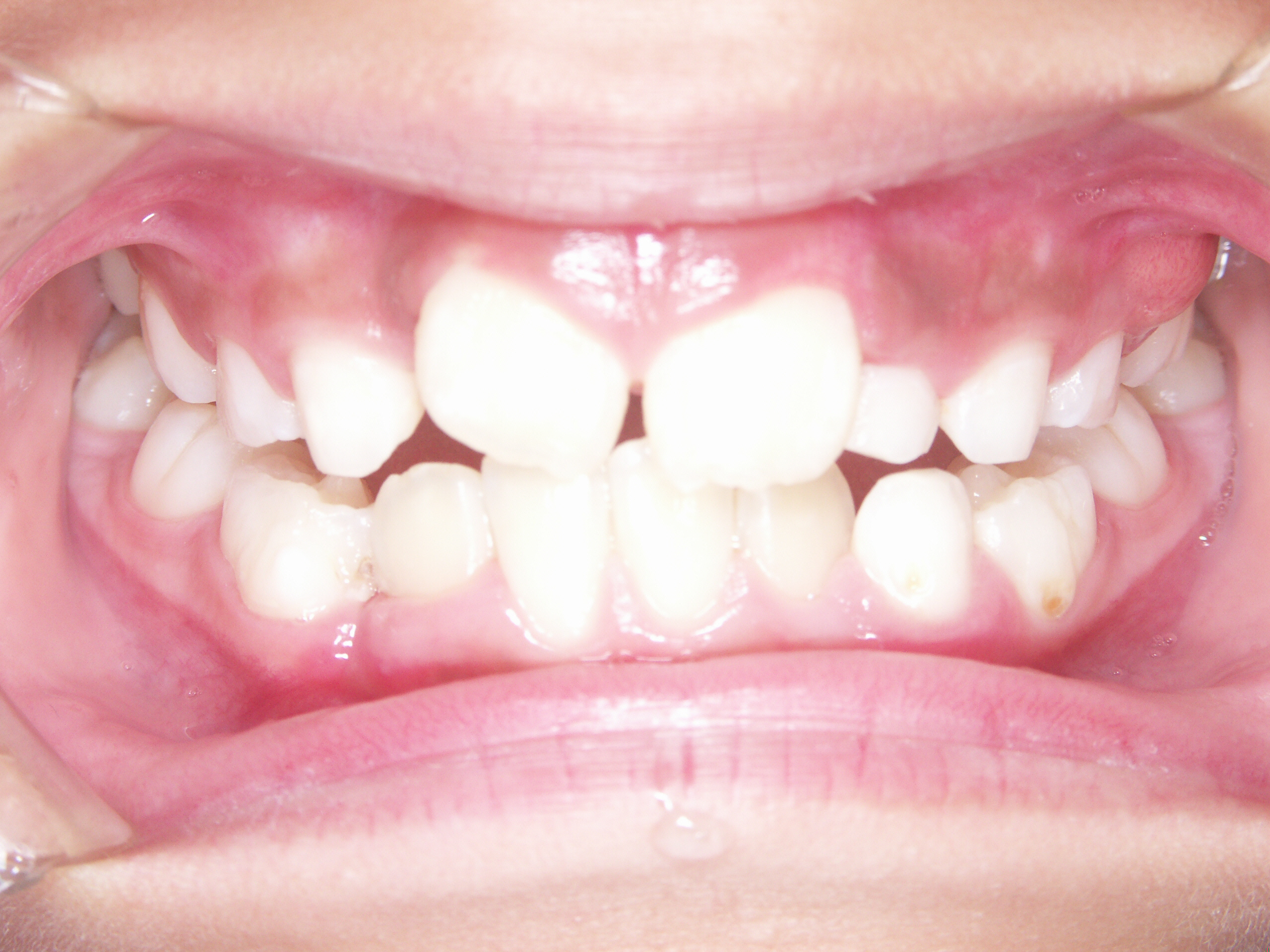 島田歯科医院ぶろぐ:歯列育形成 治療中（虫歯のないきれいな歯並びを目指して・子供の歯列矯正） - livedoor Blog（ブログ）