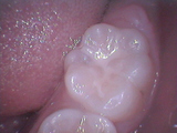 シ－ラント　虫歯予防　小児歯科2