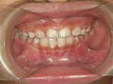 子供の歯並び・反対咬合・床矯正・小児歯科・小児矯正