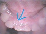 乳歯の裏側から、永久歯がはえてきた