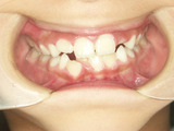 子供の歯並び・小児歯科・床矯正・小児歯列矯正・小児矯正