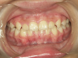 子供の歯並び・小児歯科・床矯正・小児歯列矯正・小児矯正