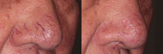 telengiectasia