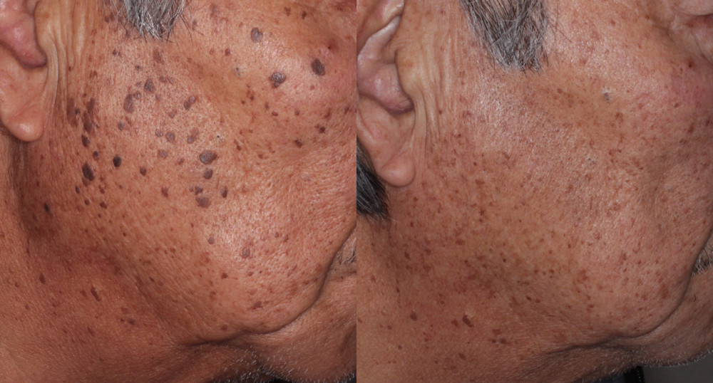 クリニックのブログ 練馬区春日町 豊島園 光が丘 田柄 の皮膚科 アレルギー科 つつじ皮膚科クリニック