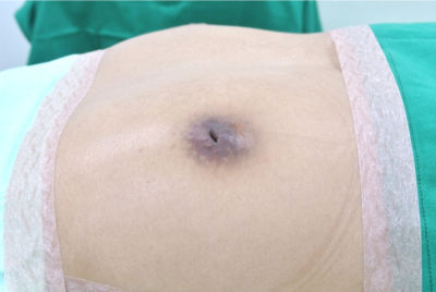 乳頭 陥没