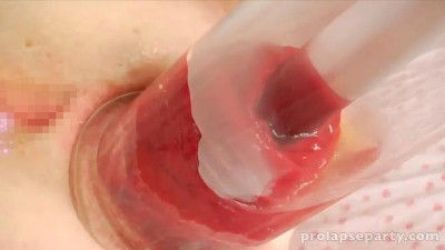 ポンプ吸引脱肛アナル 脱腸アナル