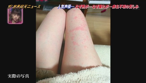 松来未祐 湿疹