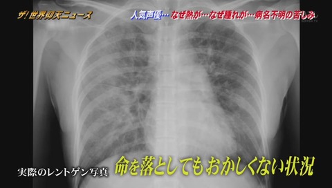 松来未祐 肺炎