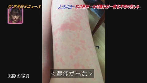 松来未祐 湿疹