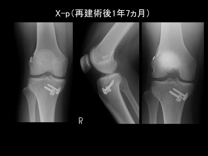 膝外側半月板後節の弁状断裂（無血管野） に対する縫合術