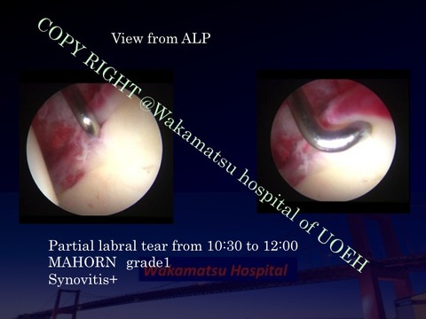 SIFFH labrum