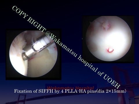 SIFFH superfixorb 1