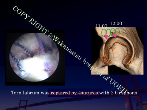 SIFFH labral repair