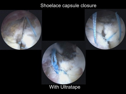 shoelace suture