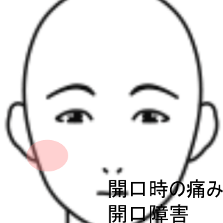 顎関節症