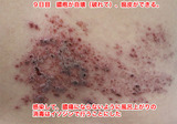 9日目自壊と痂皮