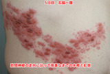 5日目右脇腹