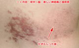 一ヶ月目背中