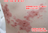 4日目脇腹