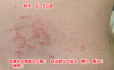 2日目背中