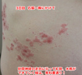 3日目脇腹