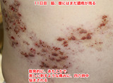 11日目脇、腹