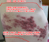 6日目 右脇腹