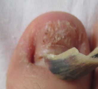 爪が根元から剥がれる原因と、新型手足口 ...
