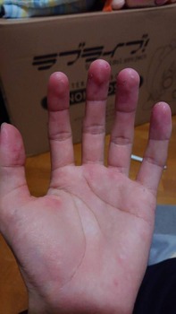 なんか最近指の皮がボロボロ剥がれるんやが…(※画像あり)