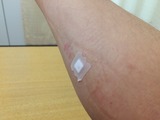 留置針あと