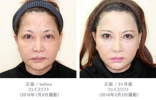 正面画像