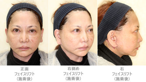 フェイスリフト施術後