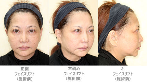 フェイスリフト施術前