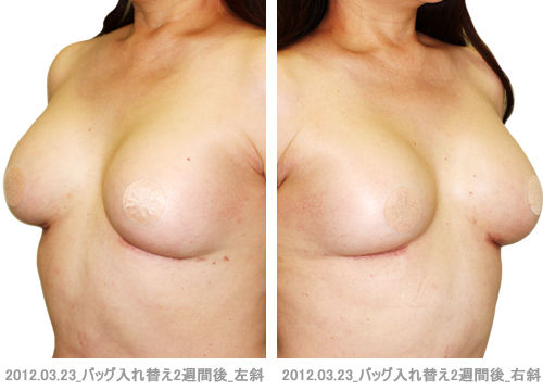 バッグ入替え_2週間後_左右