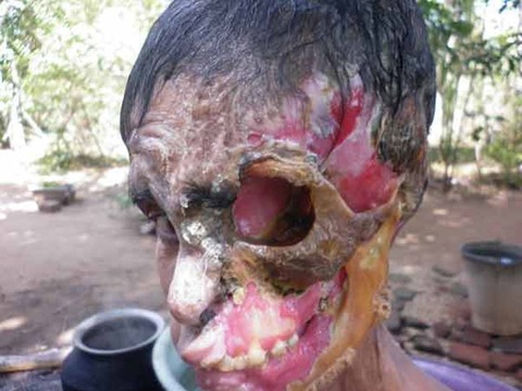 Anus flesh eating Anus flesh eating special