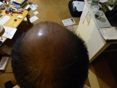 Oさま 20170116 頭頂後ろ