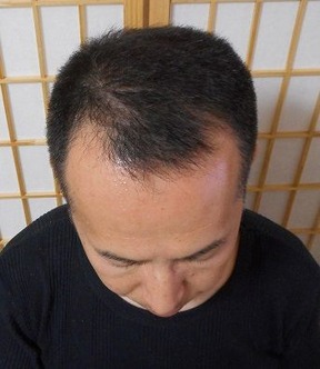 正7か月 頭頂部