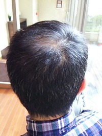 散髪前頭頂部 開始前 (2)