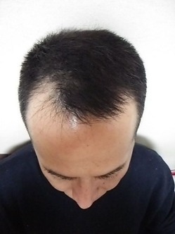 正開始時頭頂部